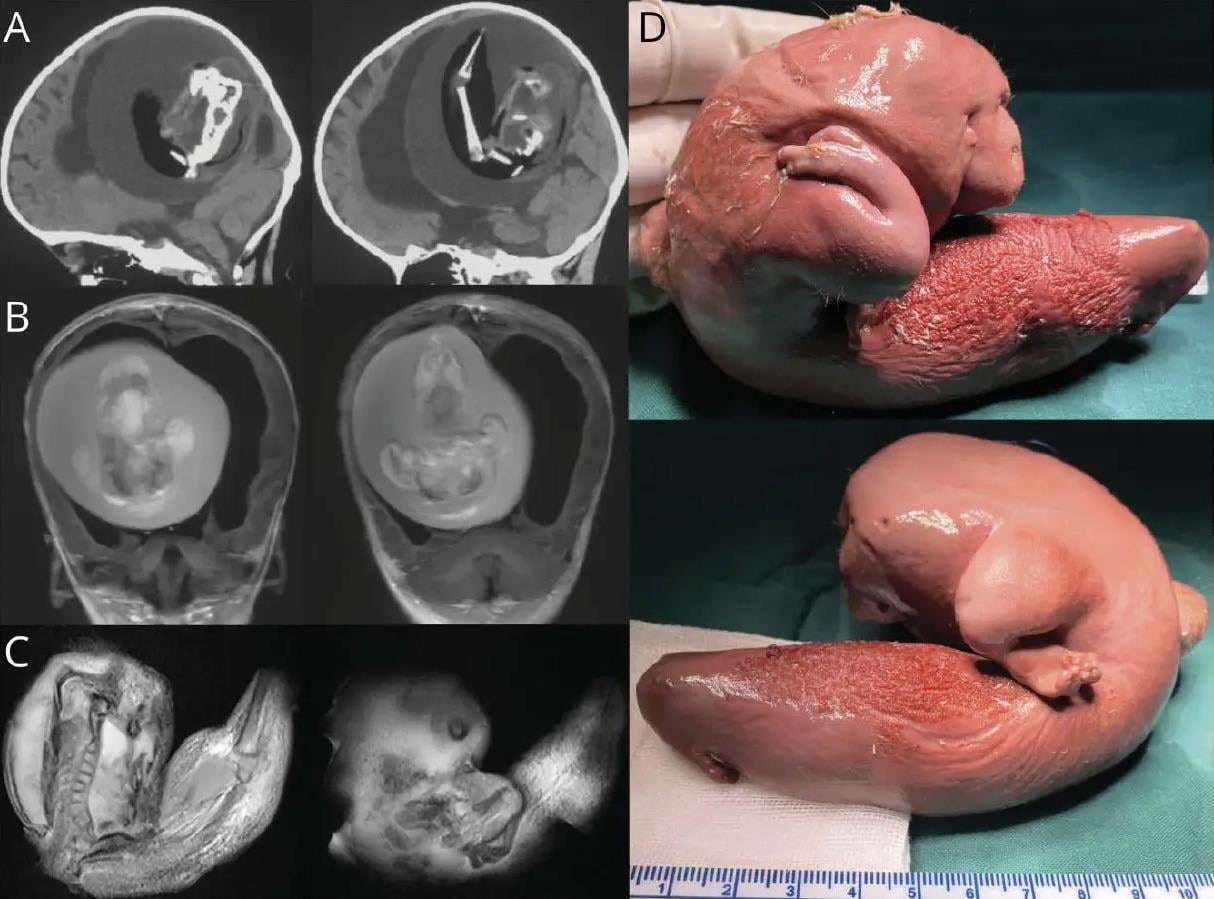 fetus found in girls skull